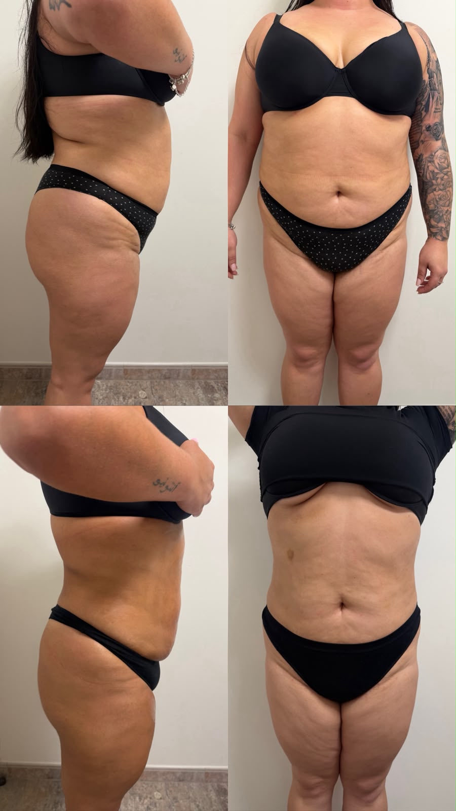 Antes e depois de protocolo estético personalizado
